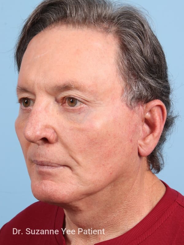Facelift Patient Photo - Case 23503 - after view-1