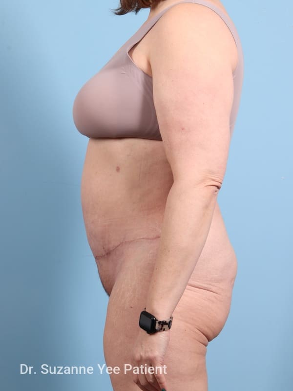 Abdominoplasty Patient Photo - Case 23693 - after view-3