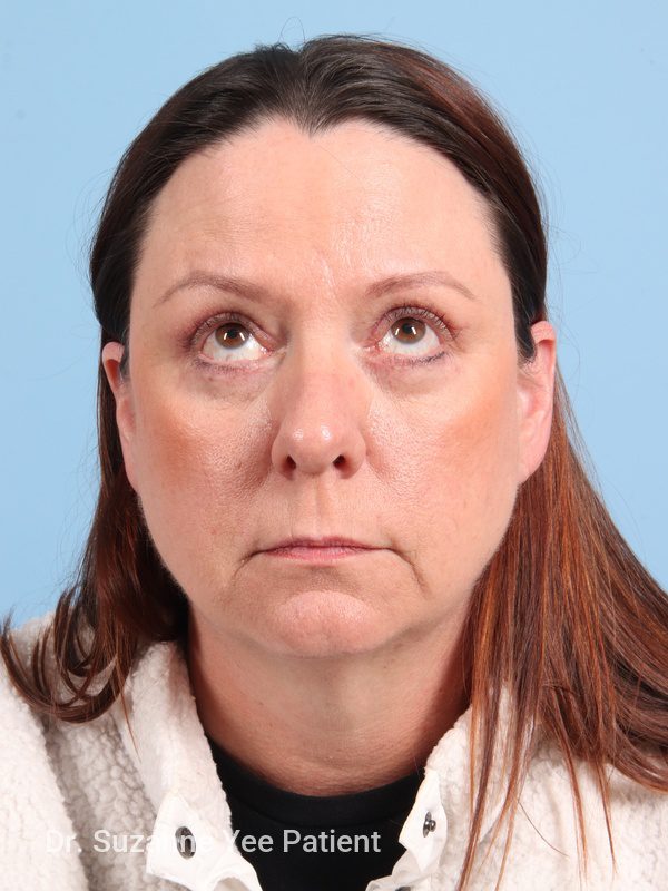 Eyelid Surgery Patient Photo - Case 23772 - after view-1