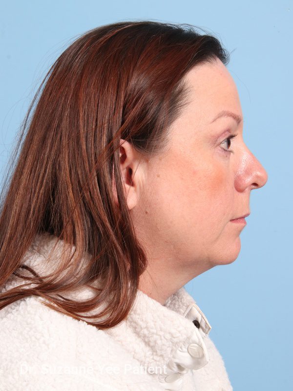 Eyelid Surgery Patient Photo - Case 23772 - after view-3