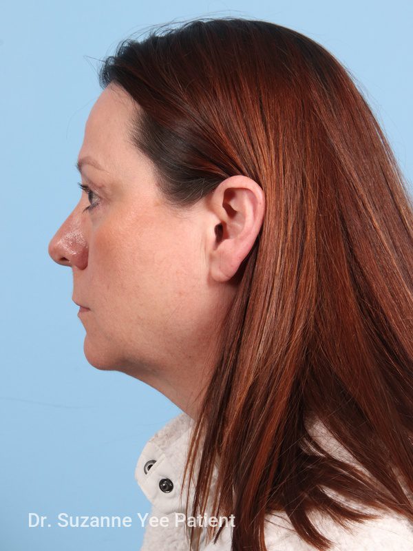 Eyelid Surgery Patient Photo - Case 23772 - after view-5