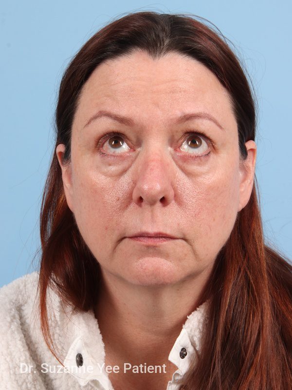 Eyelid Surgery Patient Photo - Case 23772 - before view-1