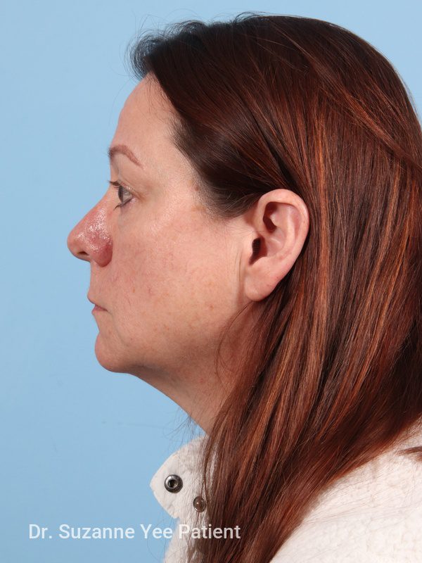 Eyelid Surgery Patient Photo - Case 23772 - before view-5