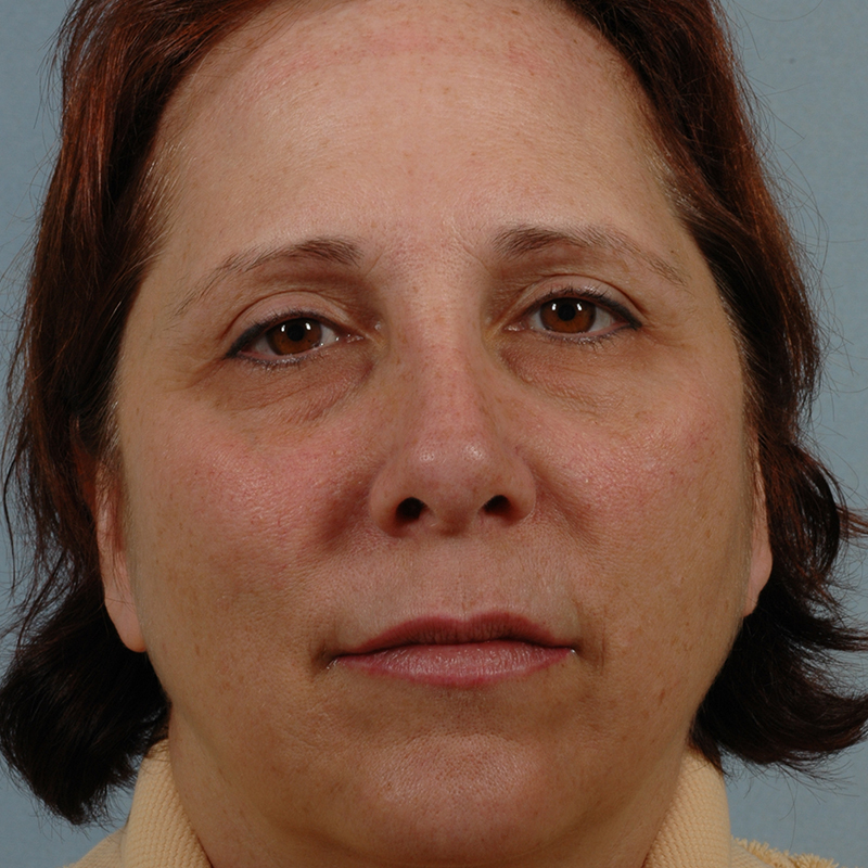 Woman in her 50s before brow lift surgery with Dr. Suzanne Yee Little Rock