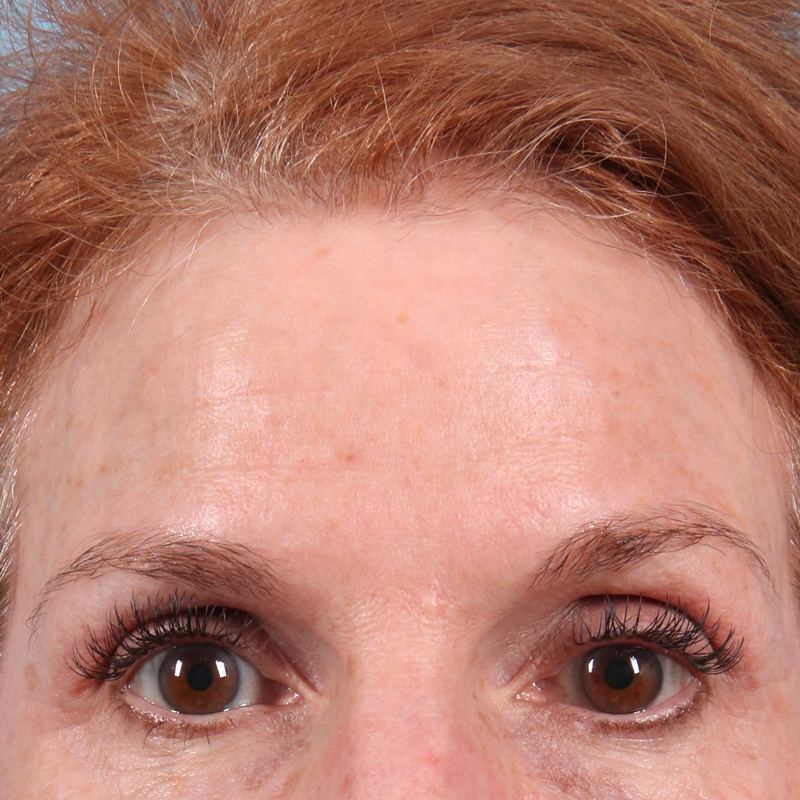 Patient after DiamondGlow facial showing improved skin clarity