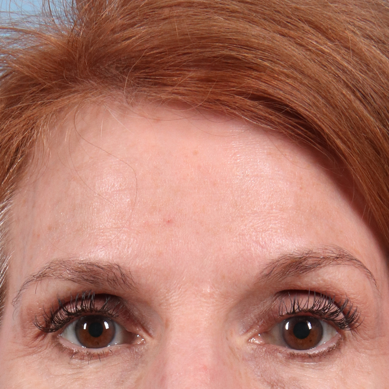 Patient before DiamondGlow facial treatment