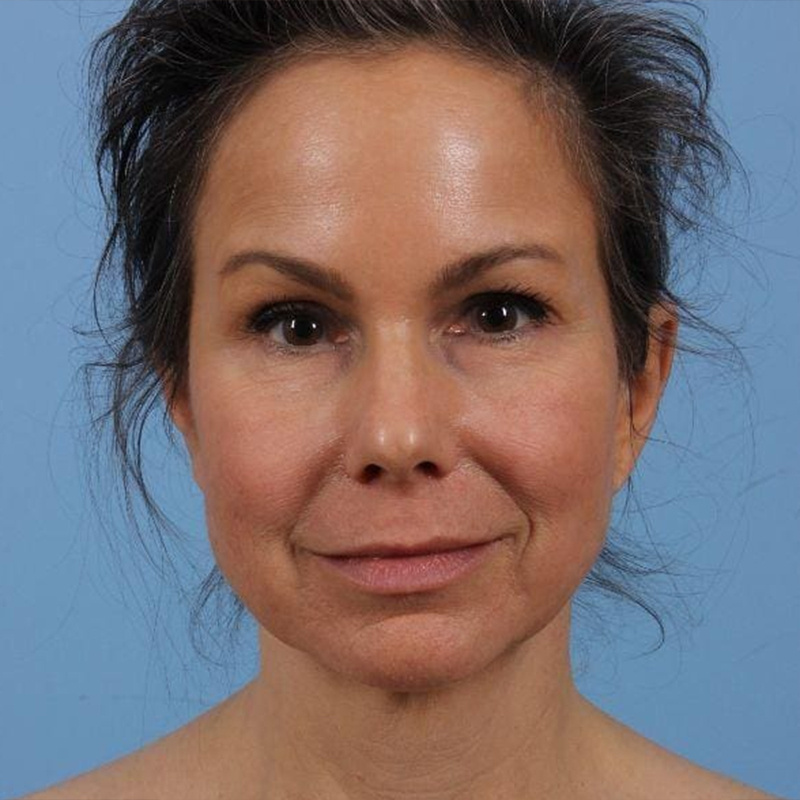 Woman before facelift surgery with Dr. Suzanne Yee Little Rock