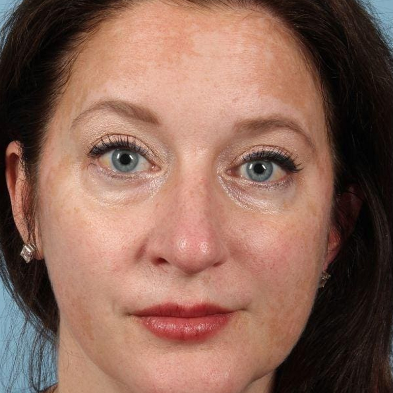 Patient before light chemical peel treatment for skin tone and texture