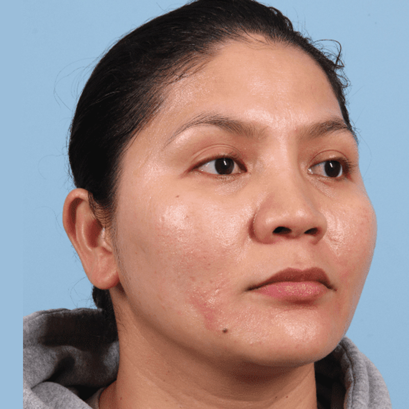 Patient before microneedling treatment for skin texture and fine lines