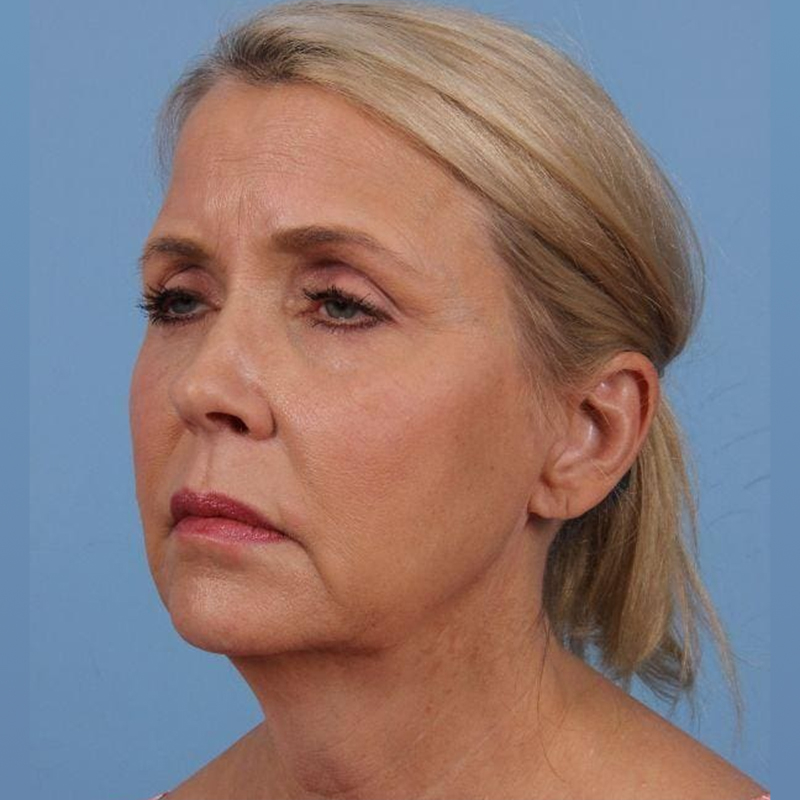 Woman in her 50s before neck lift surgery with Dr. Suzanne Yee