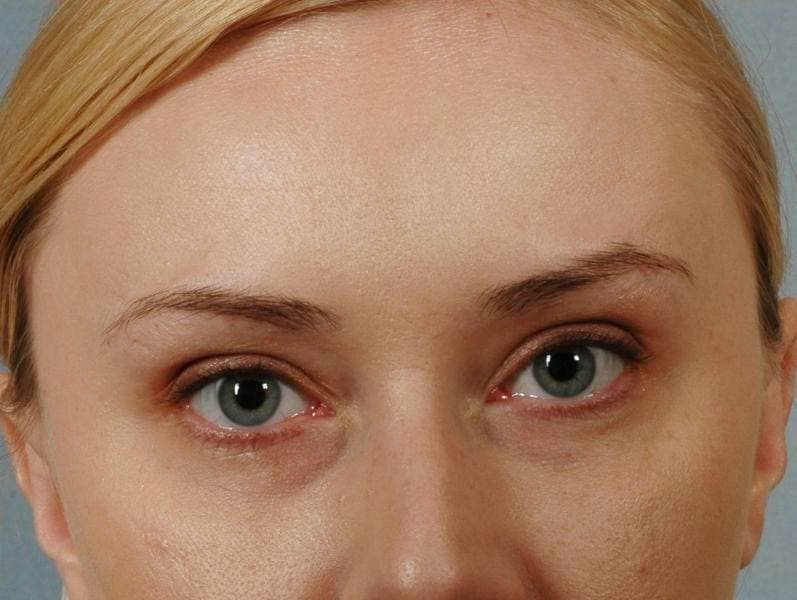 Woman after preventive neurotoxin treatment showing smoother skin