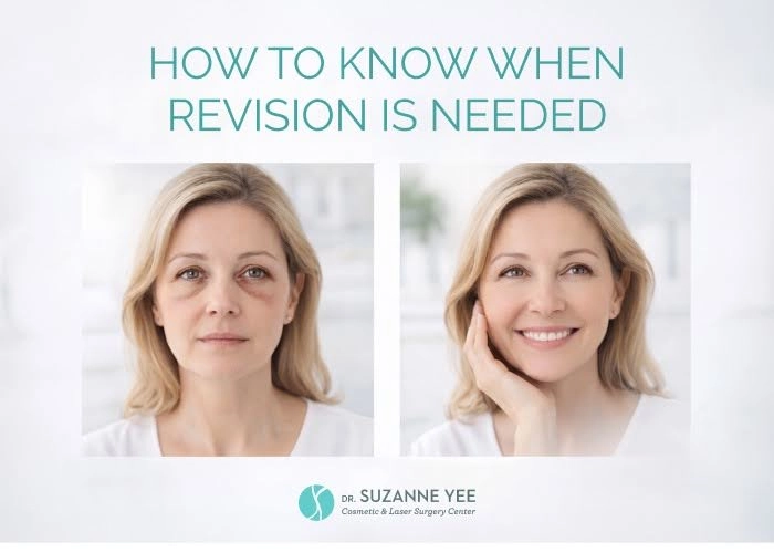 When Is Revision Blepharoplasty Needed and How Does It Work?