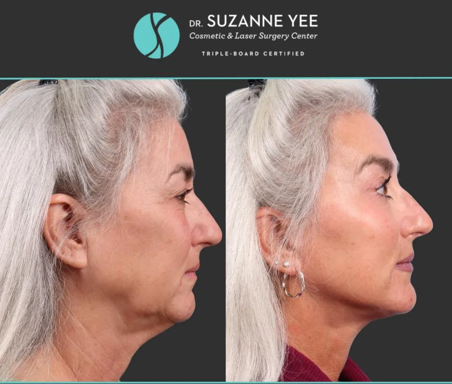Face Lift Before and After: Real Results and What to Expect