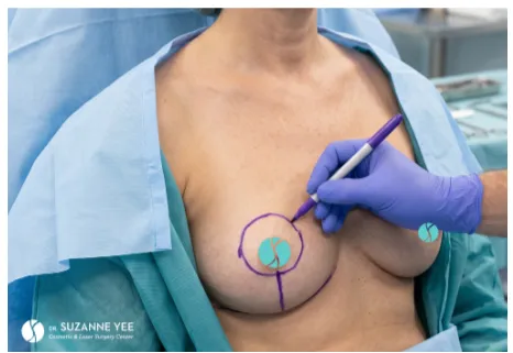 What are the different breast lift incision patterns?