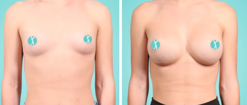 How Breast Augmentation Surgery Works, Step by Step
