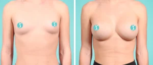 How Breast Augmentation Surgery Works, Step by Step
