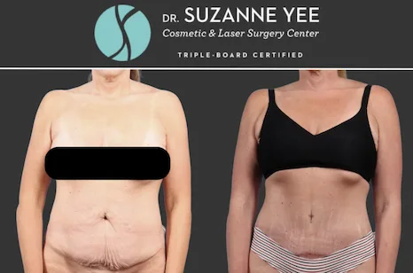 How does your surgeon decide which tummy tuck is right for you?