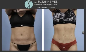 Tummy Tuck and Lipo: Combinations, Alternatives, and More