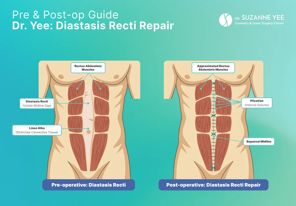 What happens during different tummy tuck procedures?