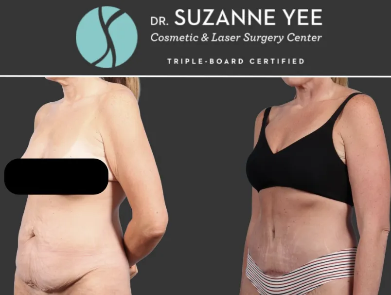 What happens during tummy tuck surgery?