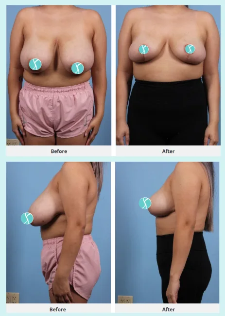 What types of scars does breast reduction surgery leave?