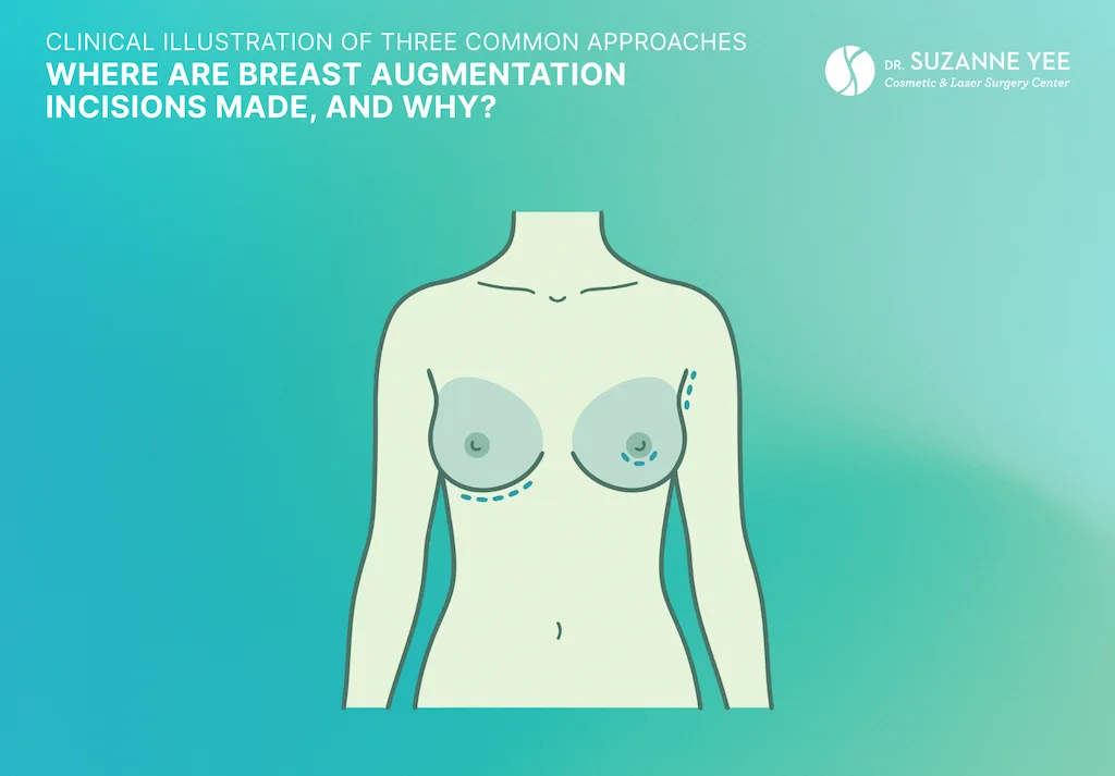 Where are breast augmentation incisions made, and why?