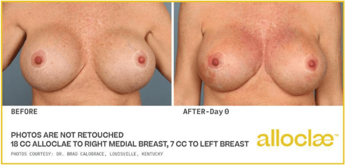 alloClae before and after &mdash; non-implant breast augmentation, front view