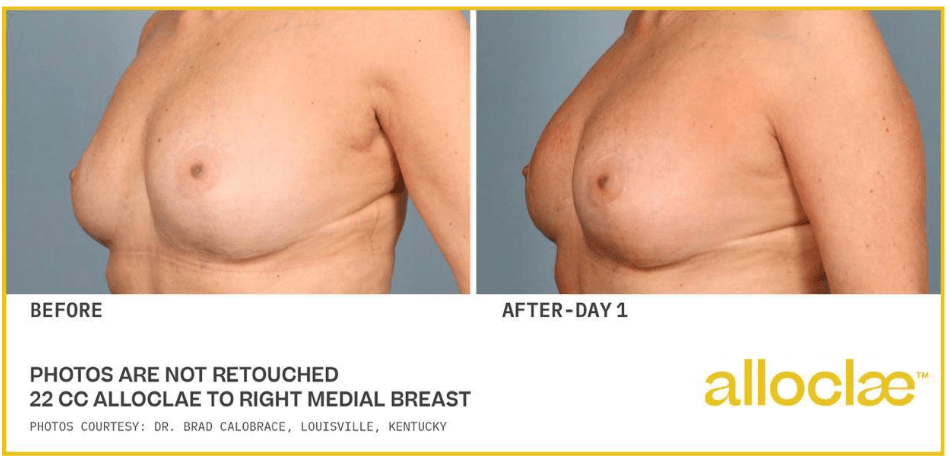 alloClae before and after &mdash; breast contour refinement, oblique view