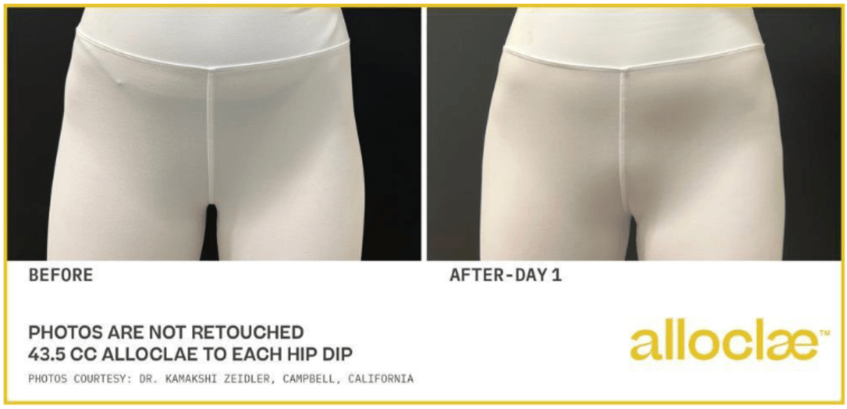 alloClae before and after &mdash; hip dip correction, front view, in leggings