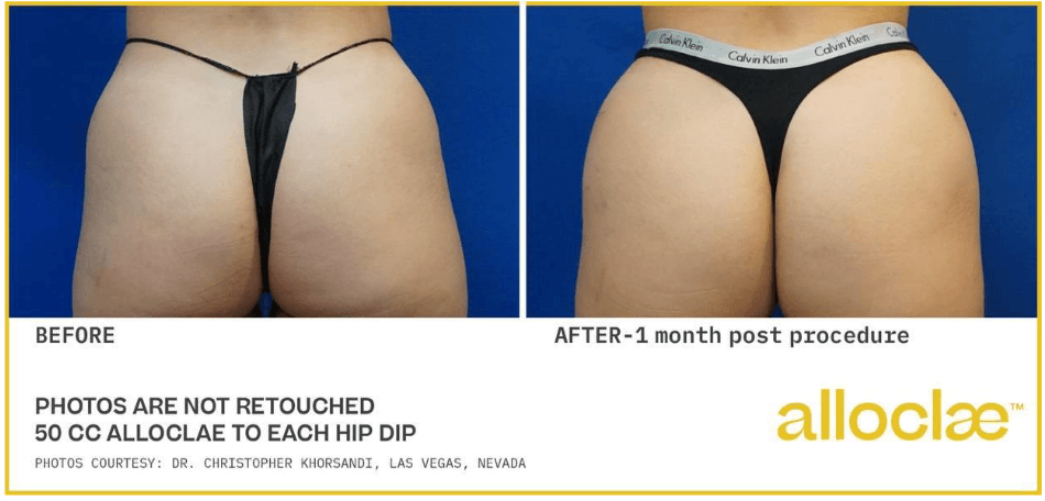 alloClae before and after &mdash; hip dip correction, posterior view, one month post-procedure