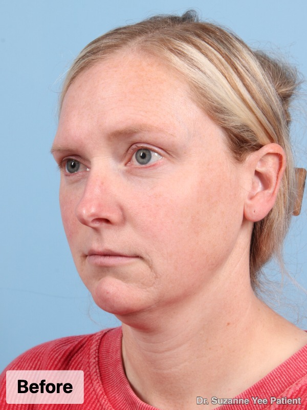 Brow Lift Patient Photo - Case 24738 - before view-4