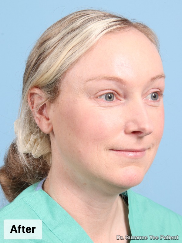 Brow Lift Patient Photo - Case 24738 - after view-1