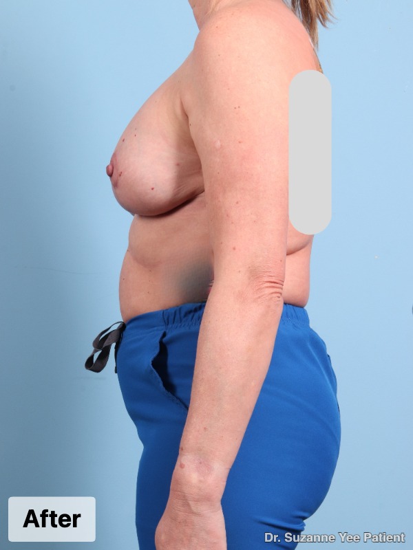 Breast Augmentation Patient Photo - Case 24750 - after view-3