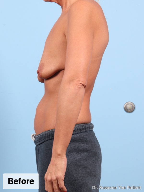 Breast Augmentation Patient Photo - Case 24801 - before view-4