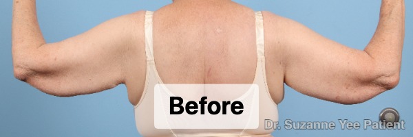Arm Lift Patient Photo - Case 24813 - after view-1
