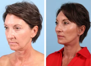 Types of Facelifts: Comparing Techniques to Find Your Fit