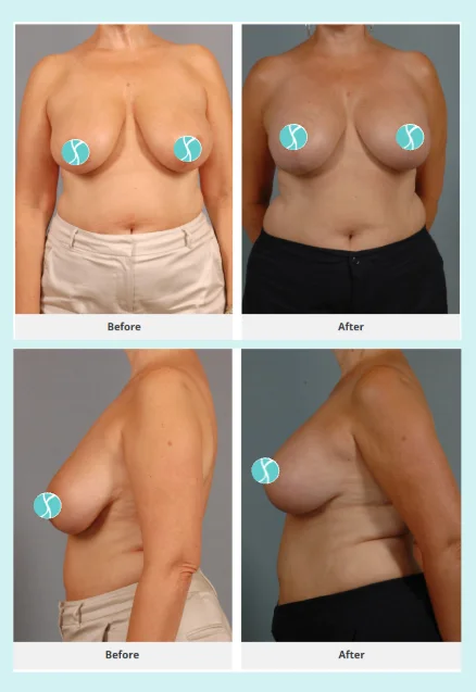 What happens during breast reduction surgery step by step?