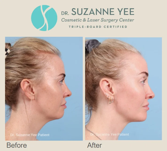 Am I a good candidate for a brow lift to refresh my upper face?