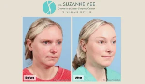 Brow Lift Before and After: Real Photos, Realistic Results