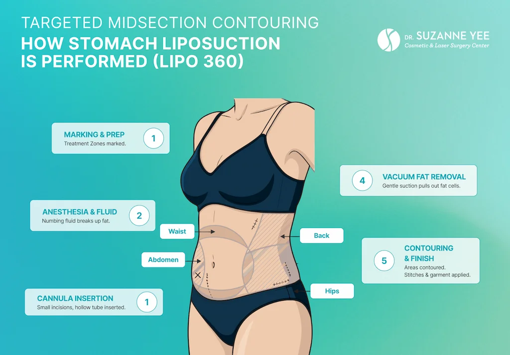 How is stomach liposuction performed?