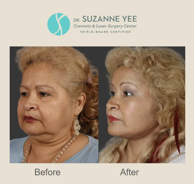What do real patients before and after photos show about realistic brow lift results?