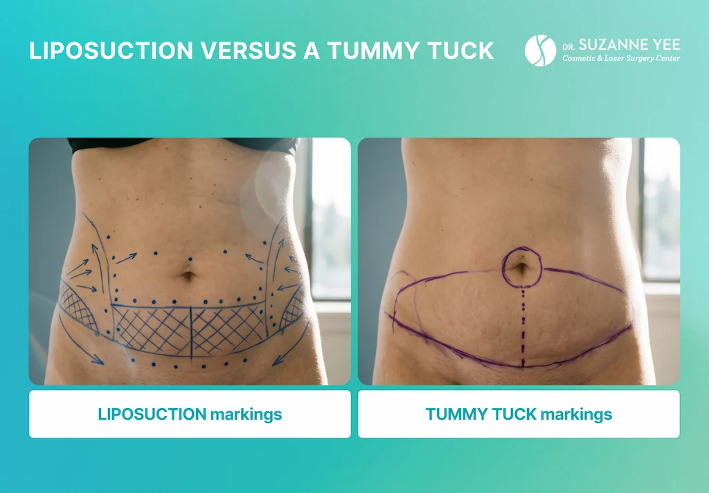 What happens during the liposuction procedure?