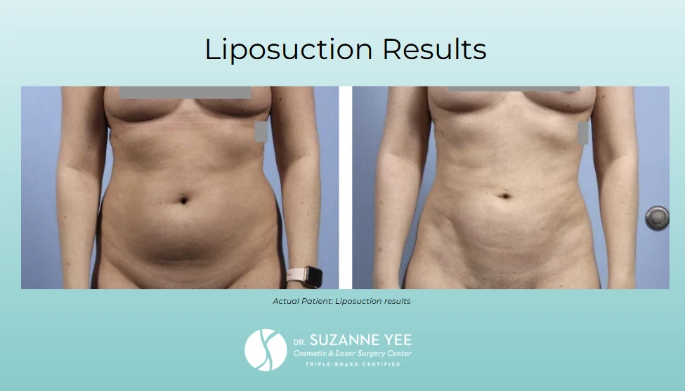 What is liposuction recovery like?