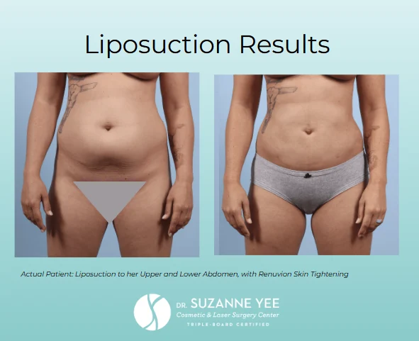 What results can you expect from stomach fat removal?