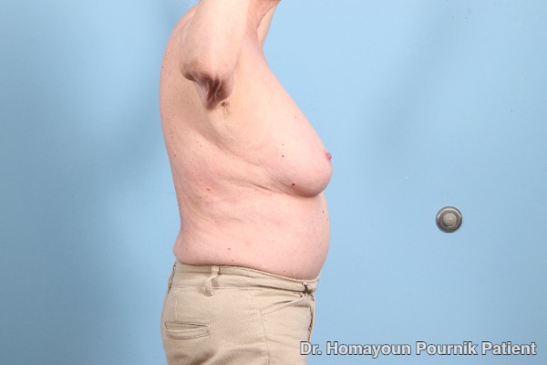Arm Lift Patient Photo - Case 25680 - before view-1