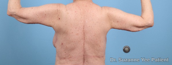 Arm Lift Patient Photo - Case 25680 - after view-5