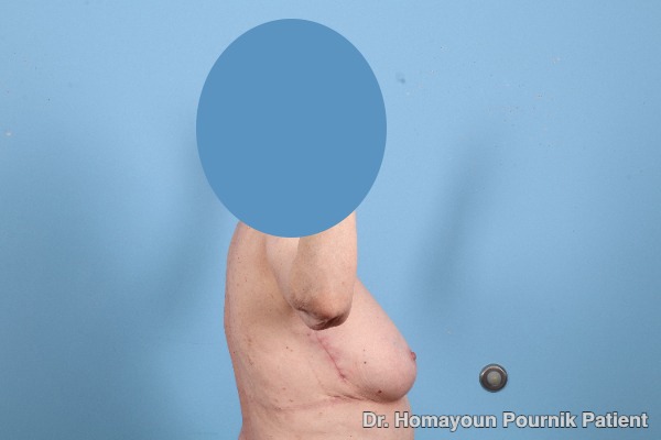 Arm Lift Patient Photo - Case 25680 - after view-1