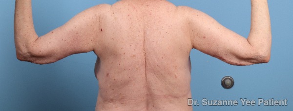 Arm Lift Patient Photo - Case 25680 - before view-5