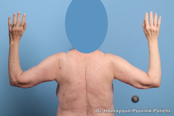 Arm Lift Patient Photo - Case 25680 - after view-4