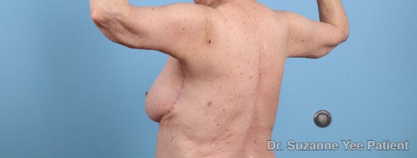 Arm Lift Patient Photo - Case 25680 - after view-3